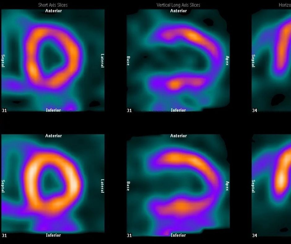 Nuclear Cardiology
