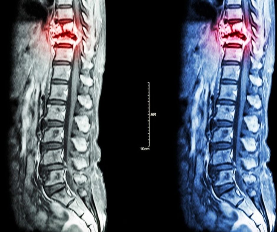 Radiolabeled Therapy for Prostate Cancer and Bone Metastasis