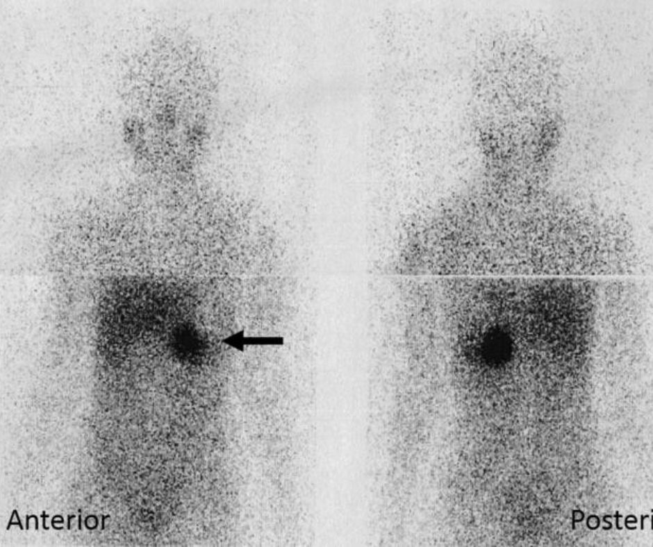I-131 mIBG Therapy & Y-90 Therapies