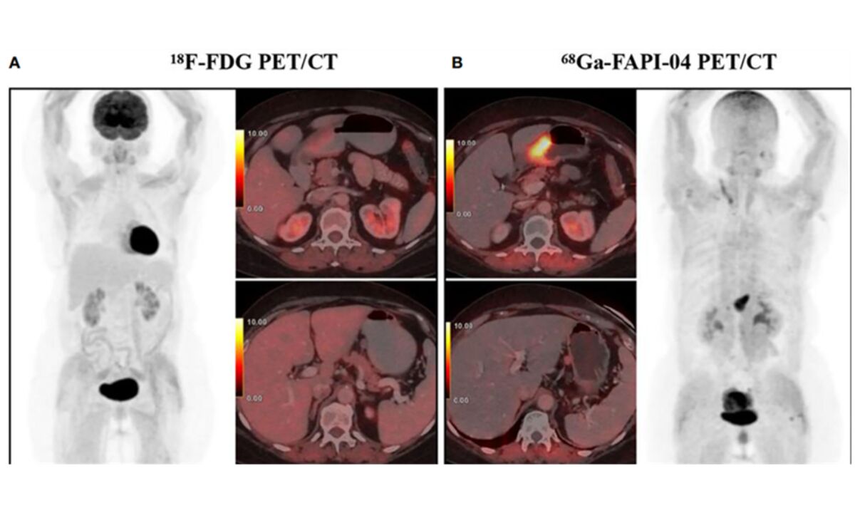Role of ⁶⁸Ga-FAPI PET-CT in Follow-Up Assessment of Oesophagogastric Junction Cancer: A Case Report